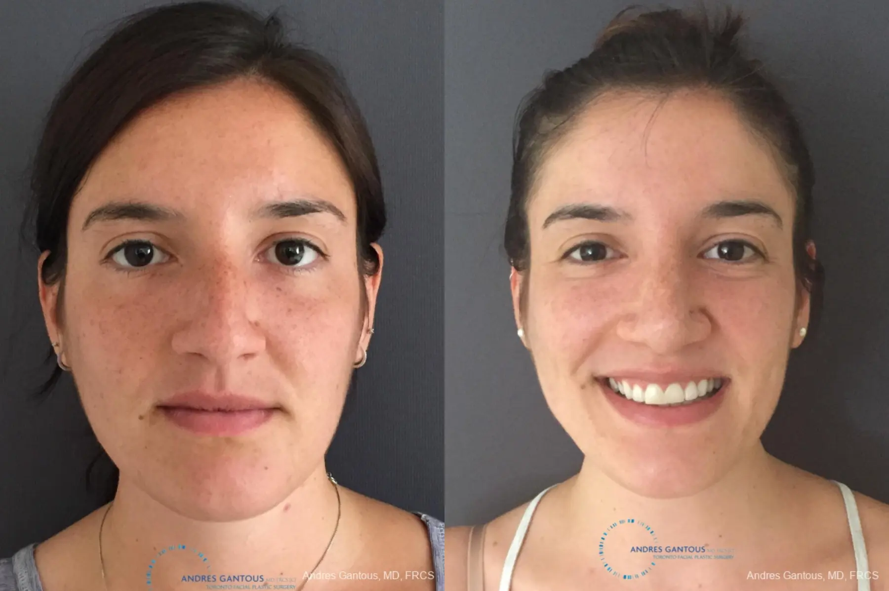 Rhinoplasty: Patient 81 - Before and After 1
