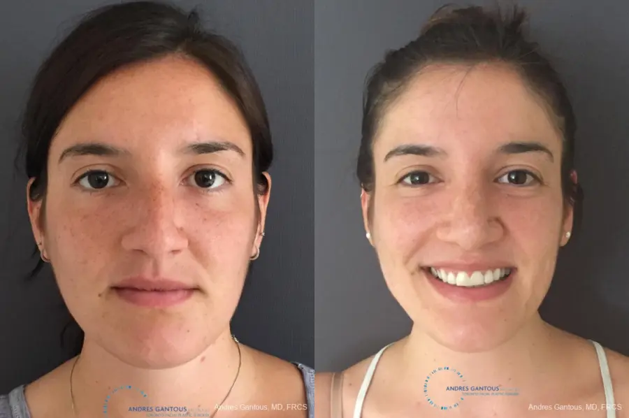 Rhinoplasty: Patient 83 - Before and After 1