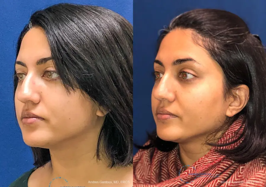 Rhinoplasty: Patient 82 - Before and After 4