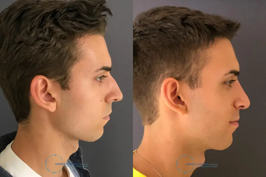 Rhinoplasty: Patient 65 - Before and After 6