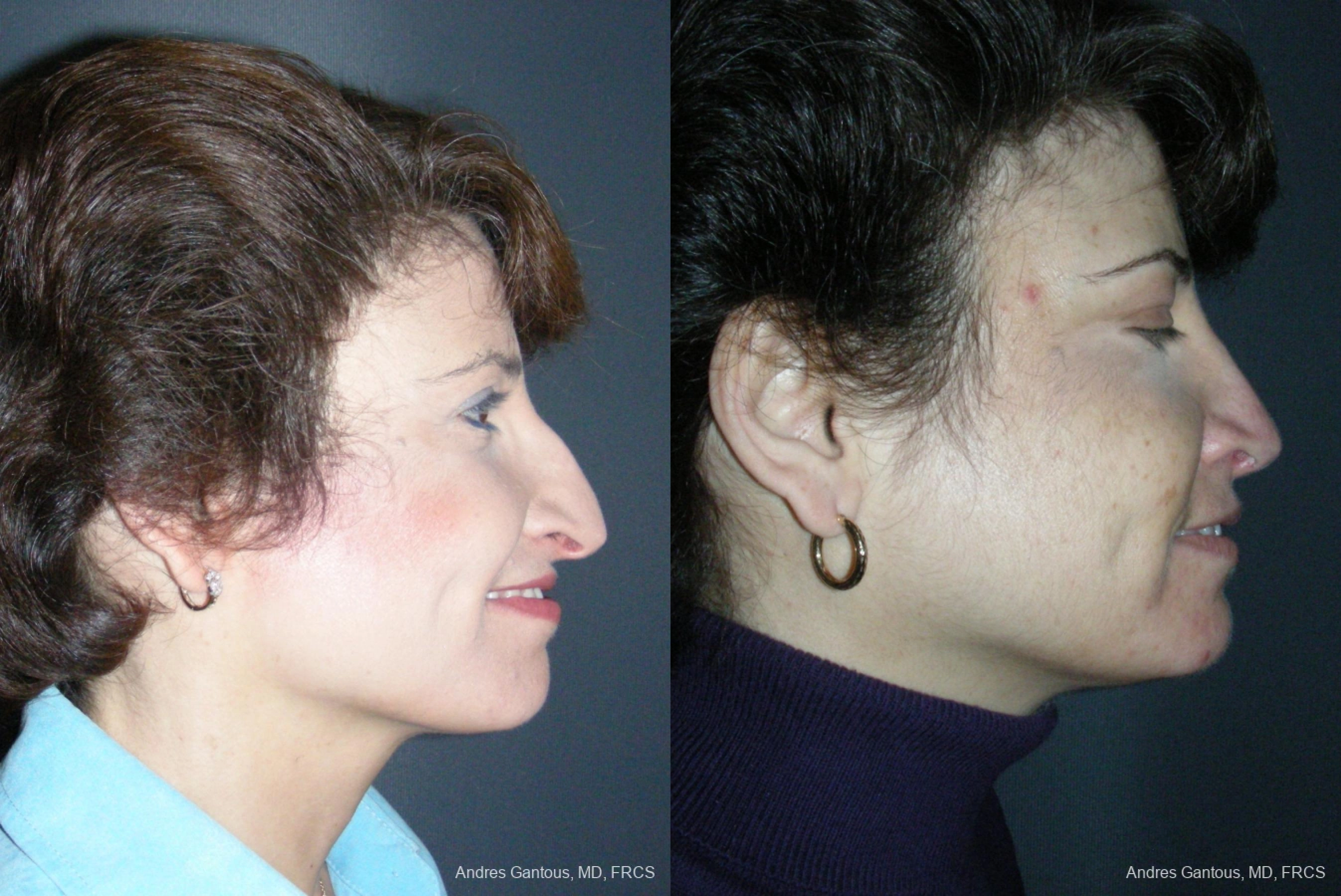 Rhinoplasty - Thumbnail 5