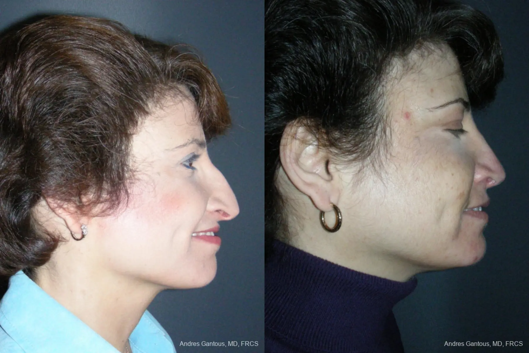 Rhinoplasty: Patient 49 - Before and After 5