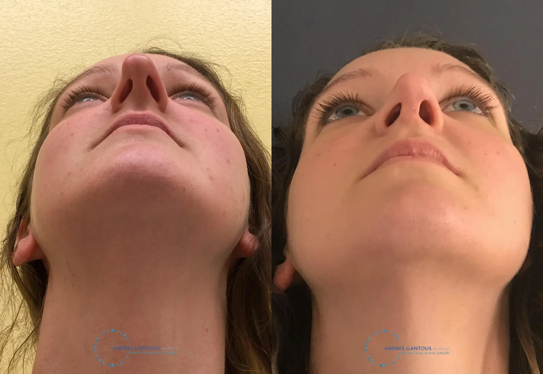 Rhinoplasty: Patient 64 - Before and After 2