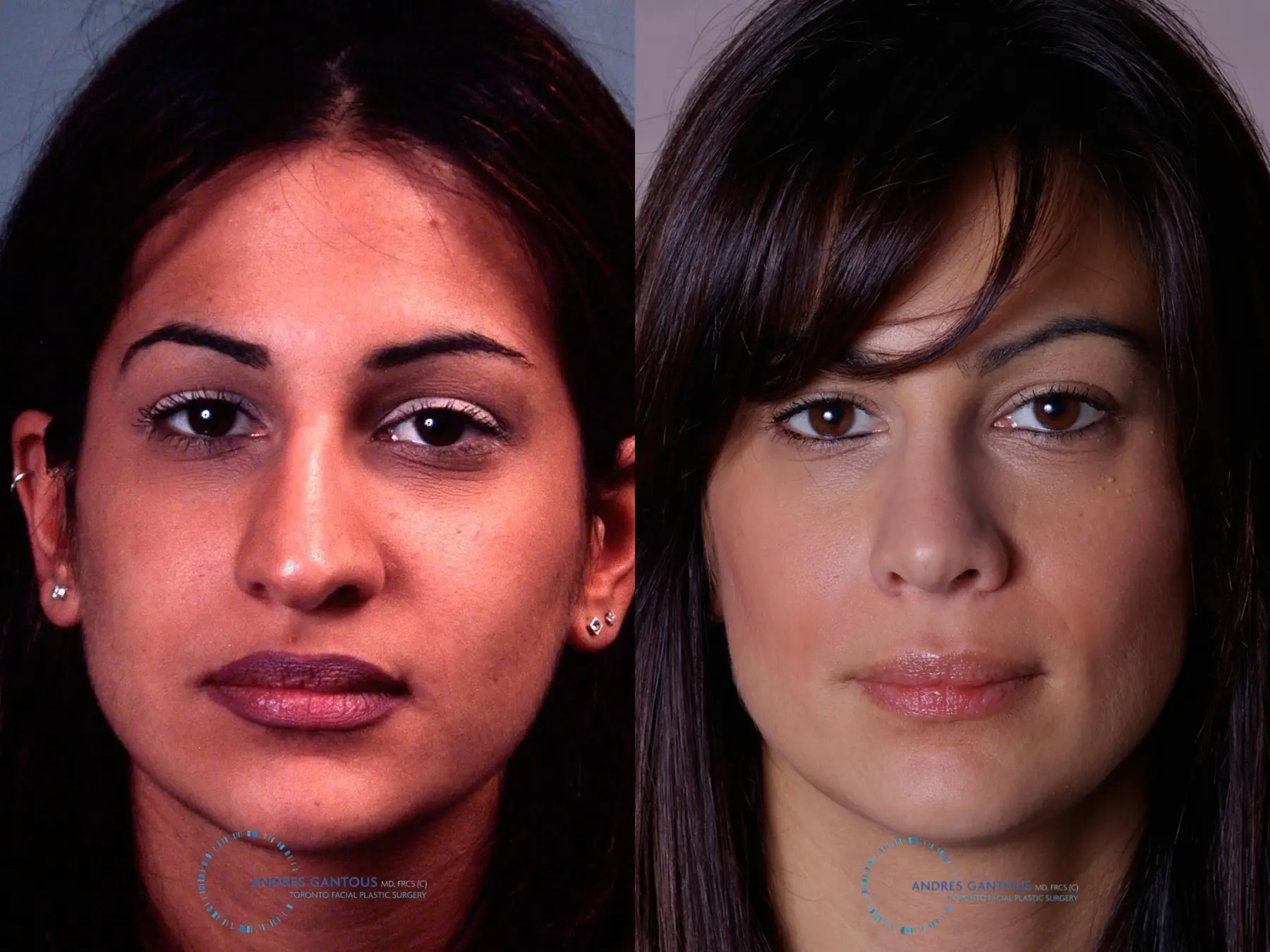 Rhinoplasty: Patient 31 - Before and After  