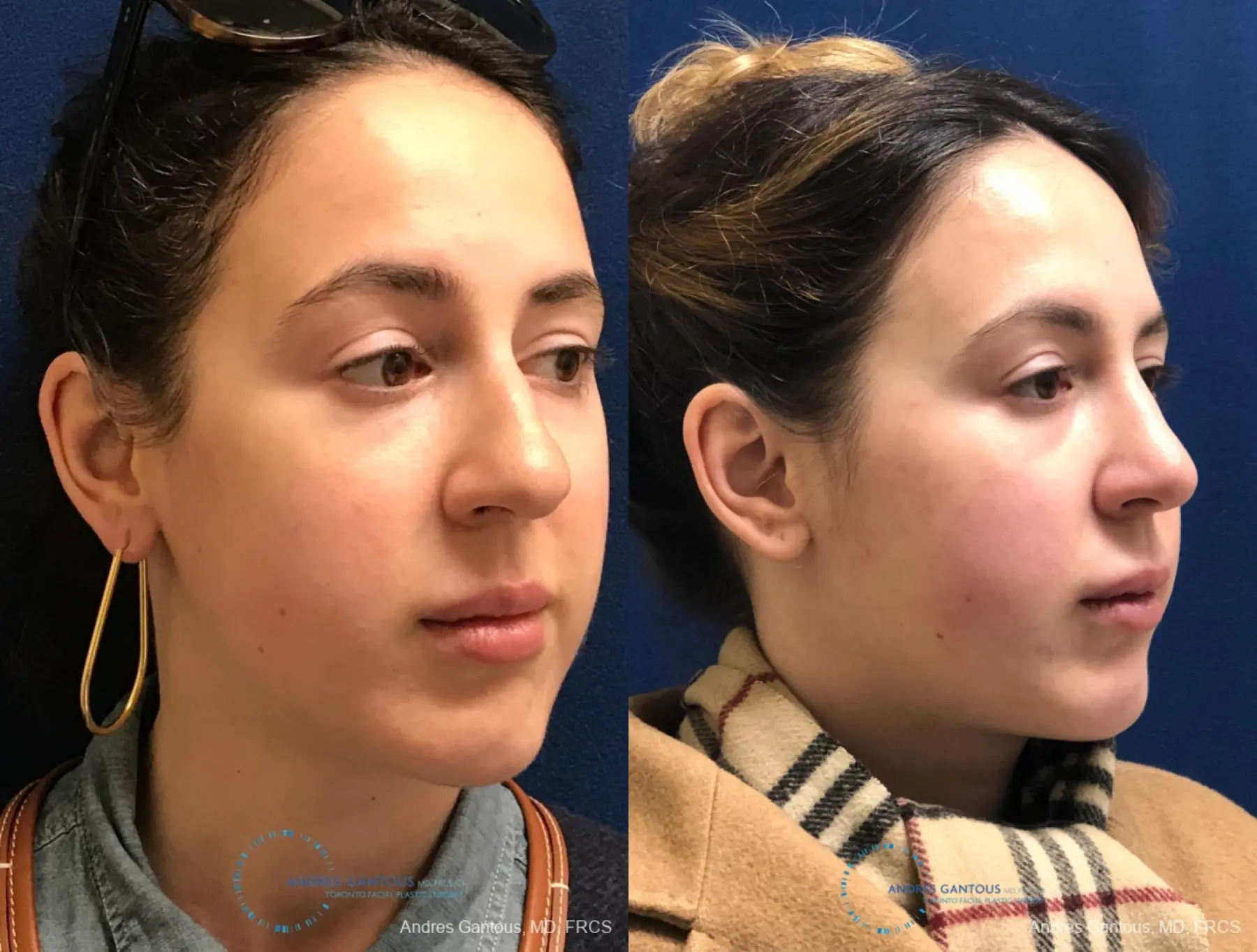 Rhinoplasty: Patient 82 - Before and After 3