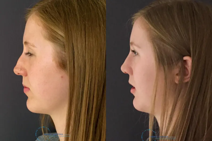 Rhinoplasty: Patient 26 - Before and After 5