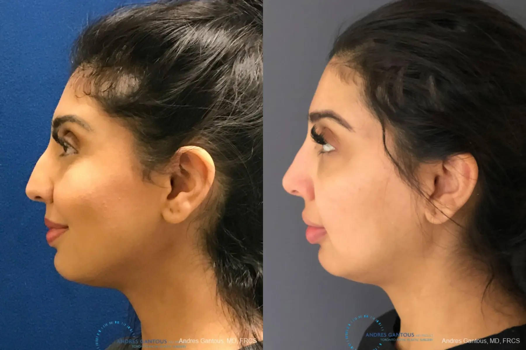 Rhinoplasty: Patient 75 - Before and After 6
