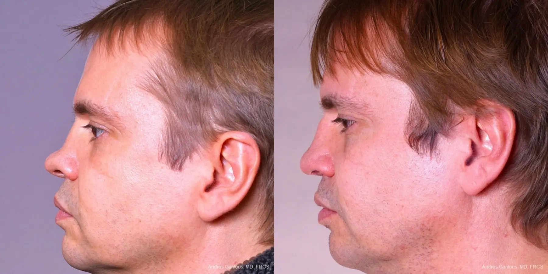 Rhinoplasty: Patient 38 - Before and After 5