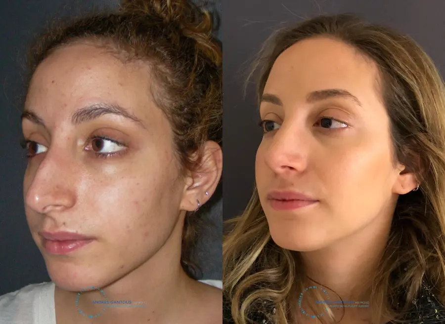 Rhinoplasty: Patient 72 - Before and After 4
