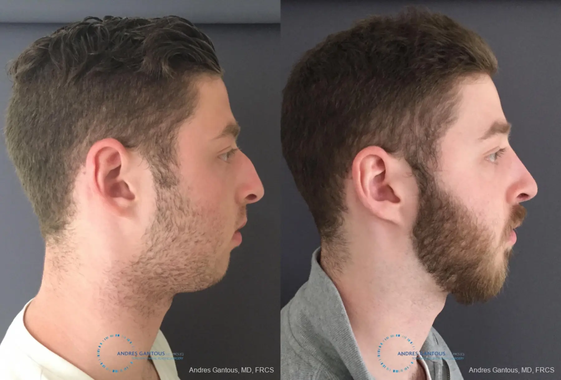 Rhinoplasty: Patient 94 - Before and After 5