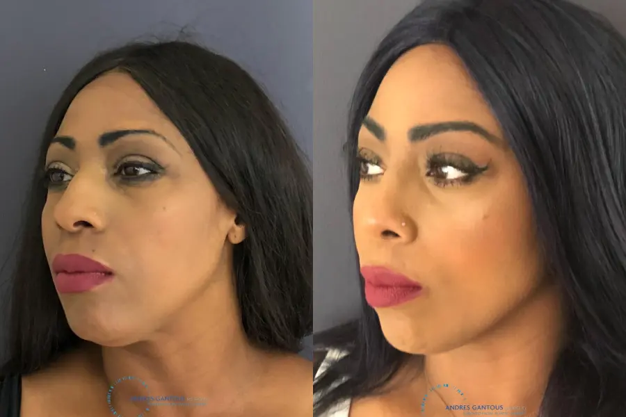 Rhinoplasty: Patient 66 - Before and After 3