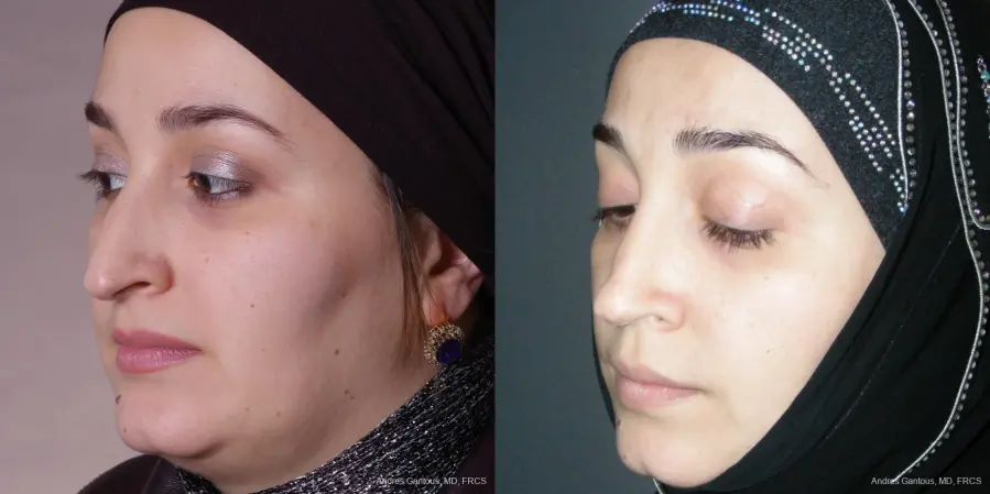 Rhinoplasty: Patient 51 - Before and After 2