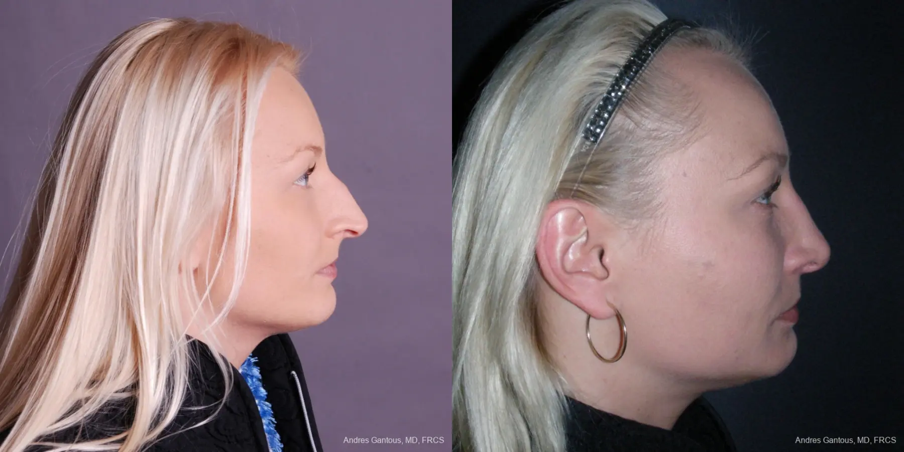 Rhinoplasty: Patient 48 - Before and After 3