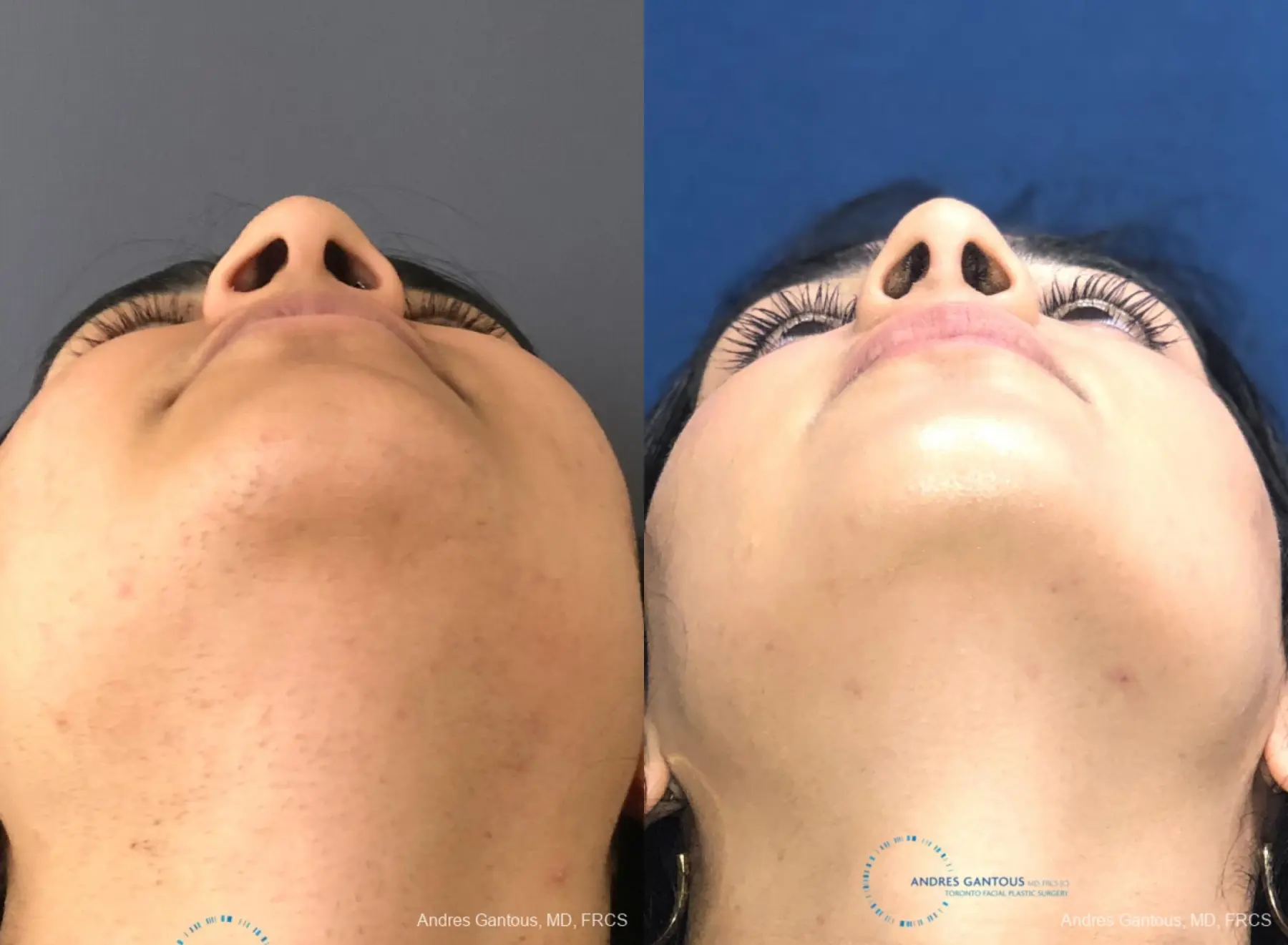 Rhinoplasty: Patient 84 - Before and After 2