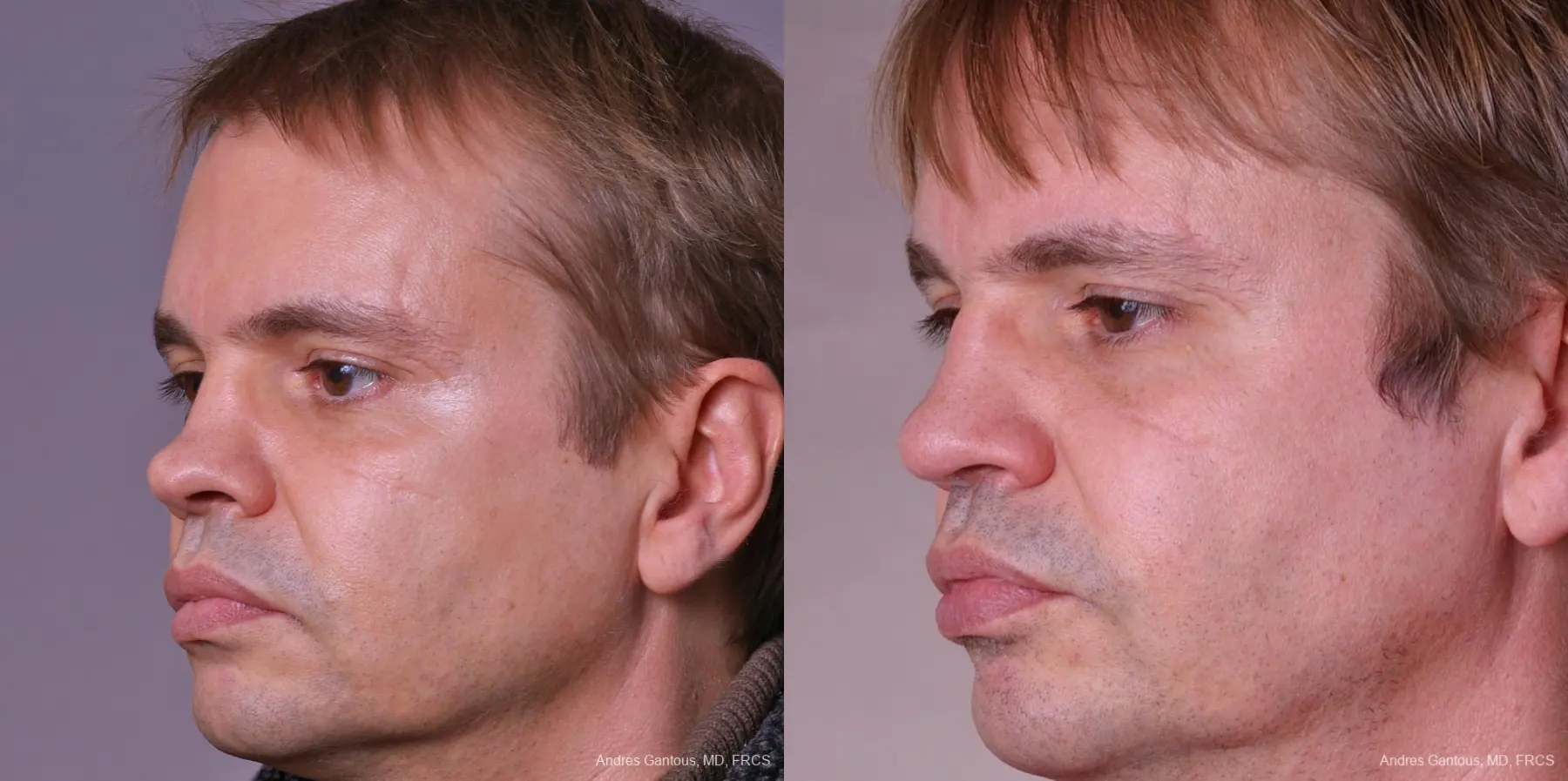 Rhinoplasty: Patient 38 - Before and After 3