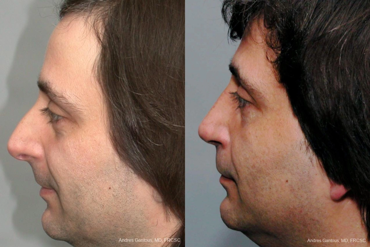 Rhinoplasty - Thumbnail 3