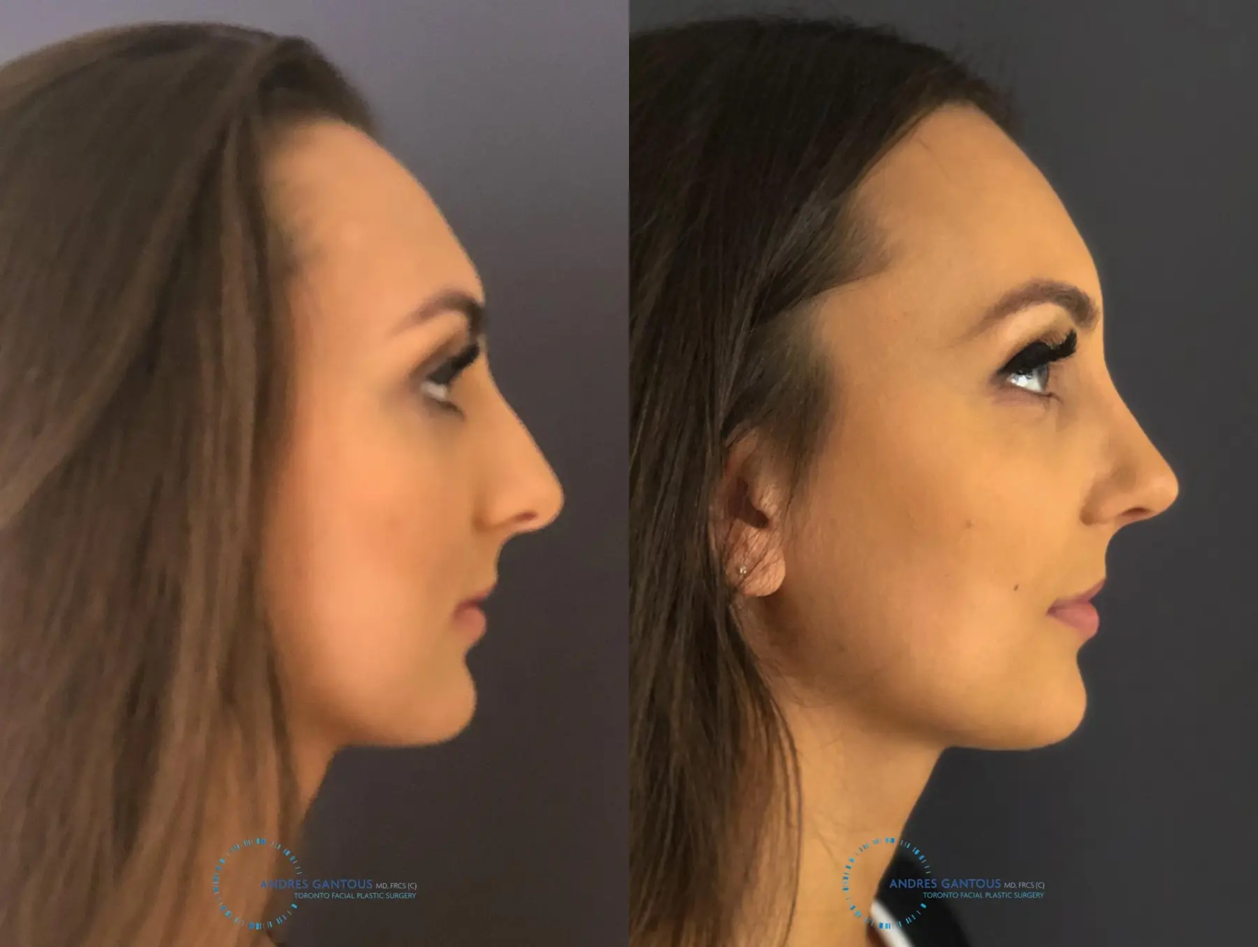 Rhinoplasty: Patient 11 - Before and After 6