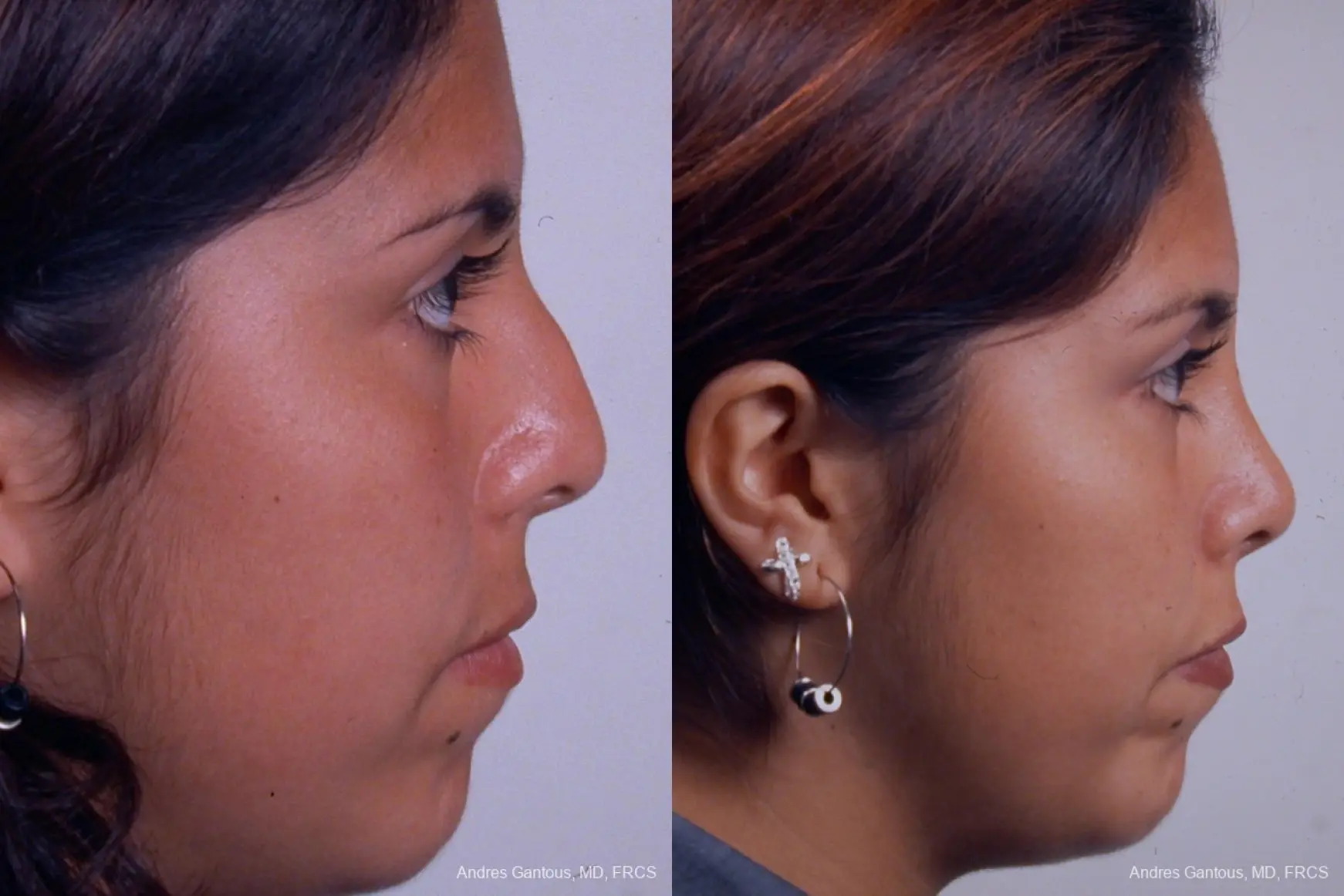 Rhinoplasty: Patient 19 - Before and After 4