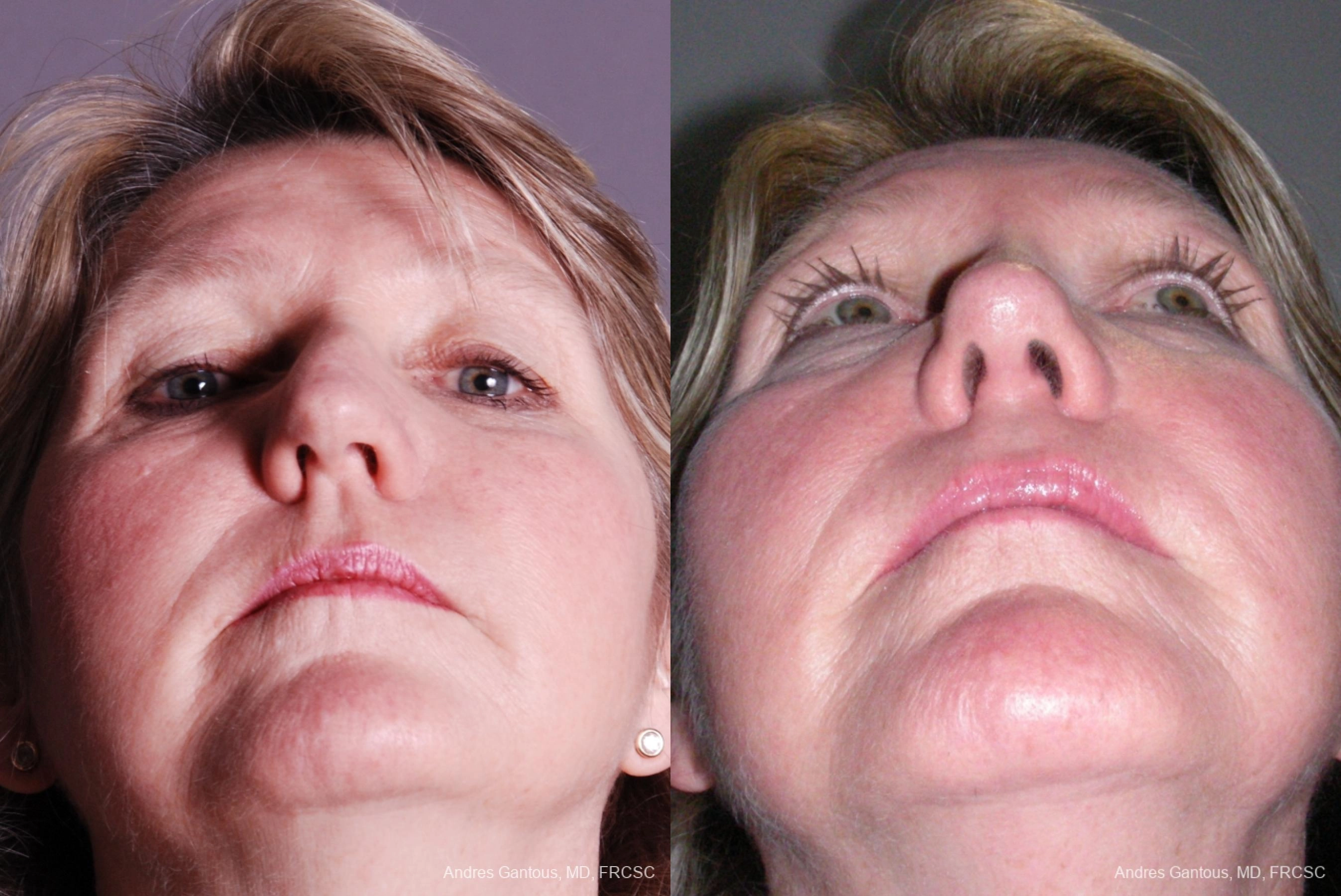 Rhinoplasty - Thumbnail 5