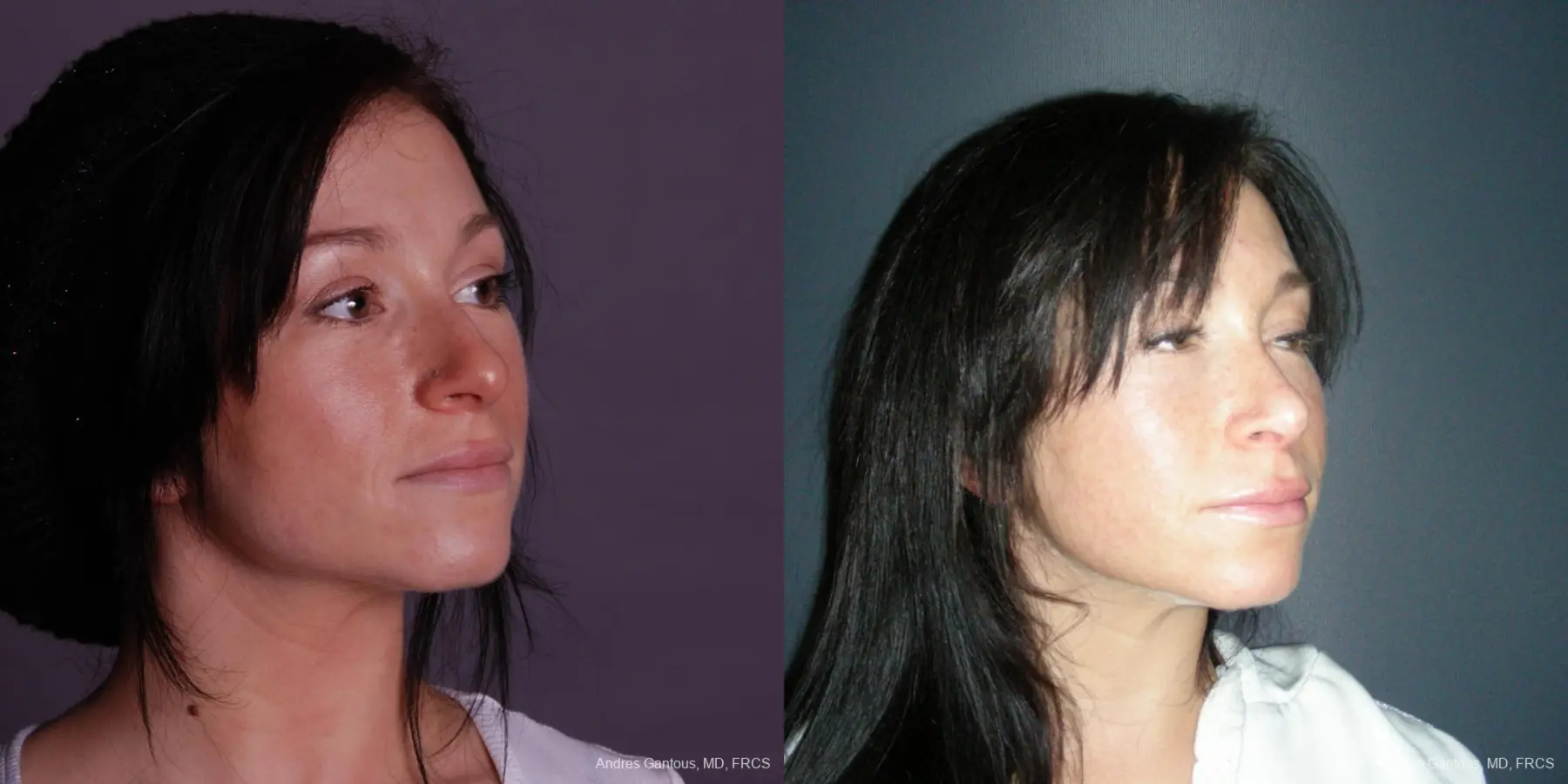 Rhinoplasty: Patient 46 - Before and After 2