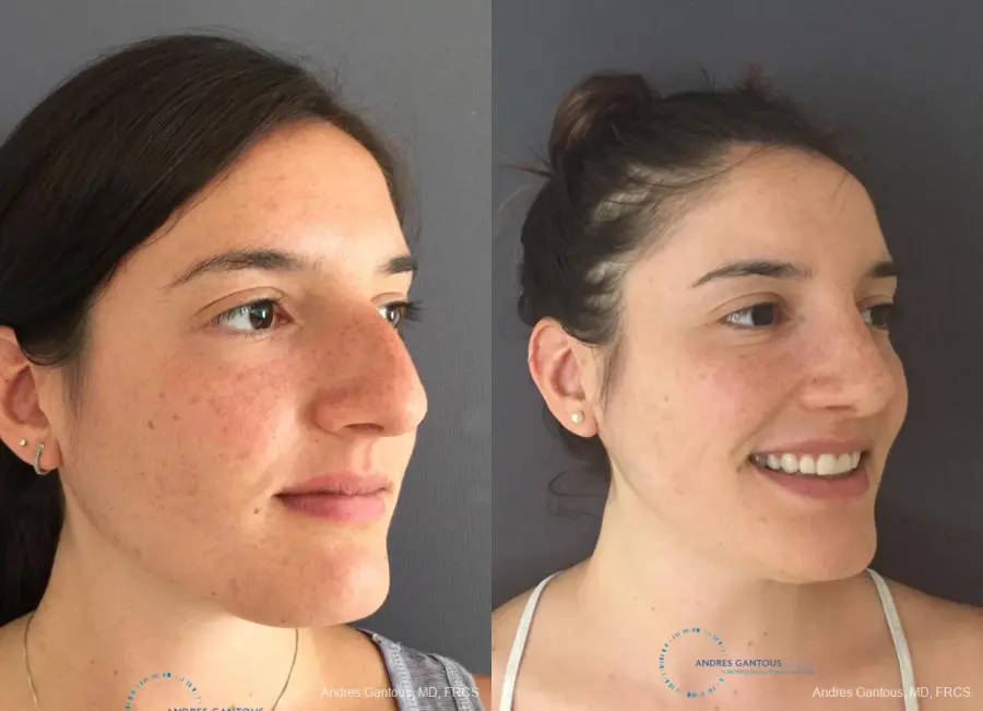 Rhinoplasty: Patient 83 - Before and After 3