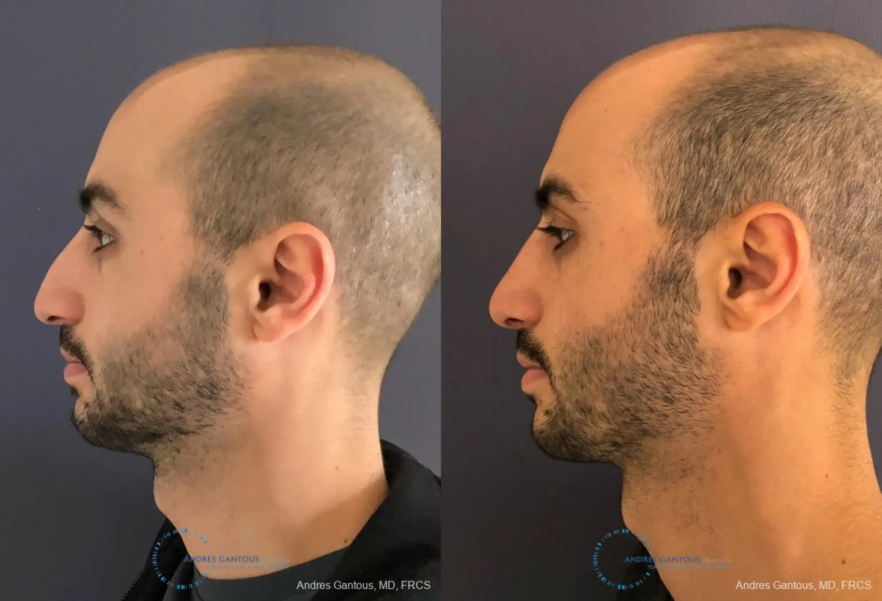 Rhinoplasty: Patient 89 - Before and After 6
