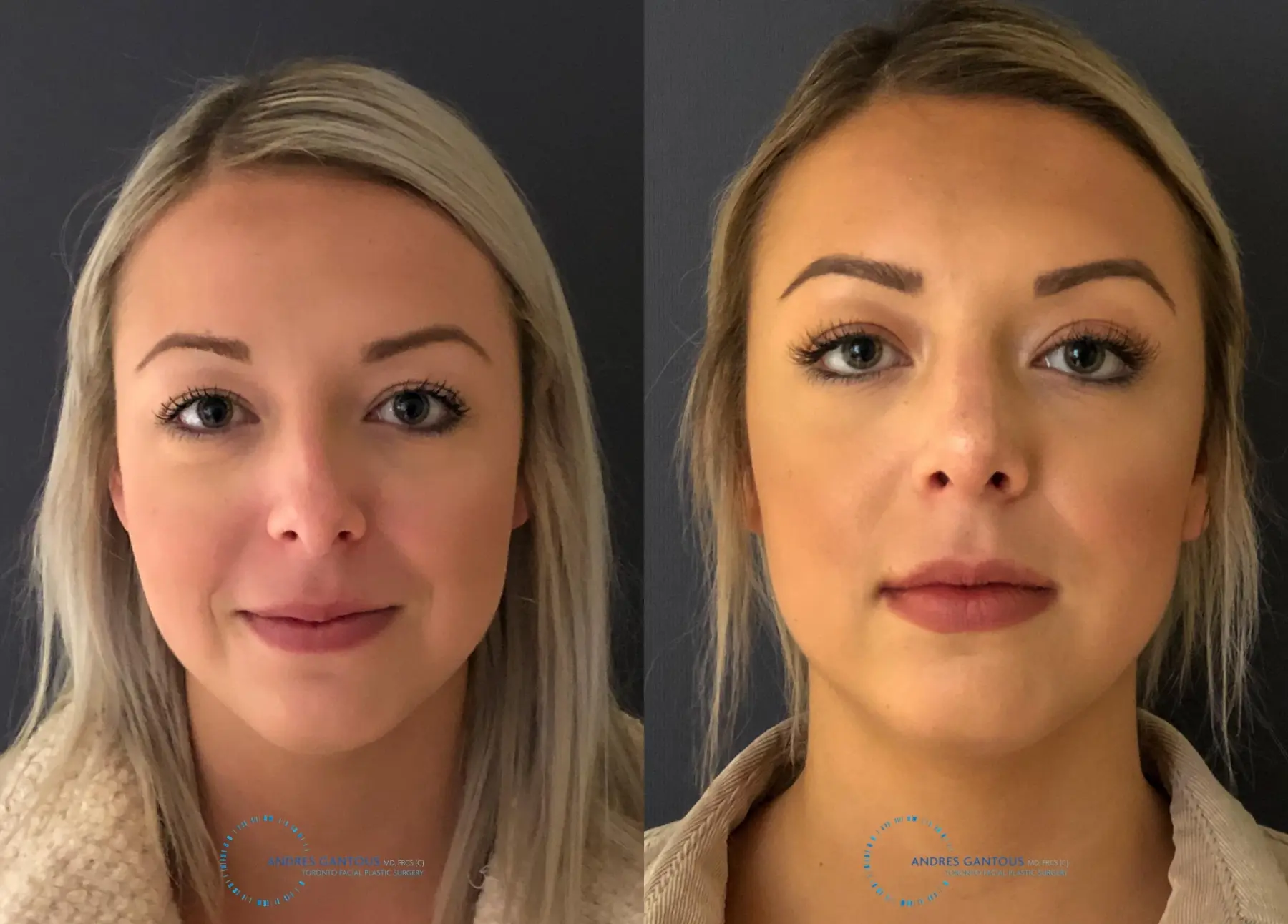 Rhinoplasty: Patient 71 - Before and After 1