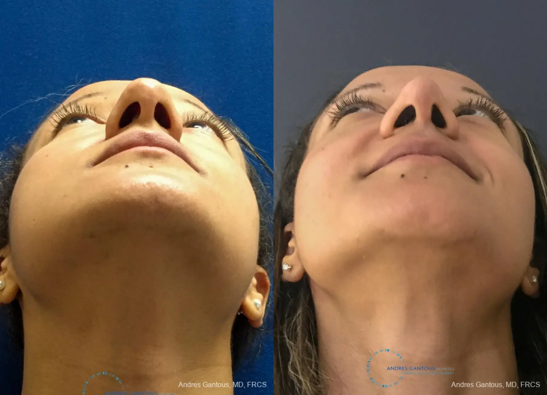 Rhinoplasty: Patient 93 - Before and After 2
