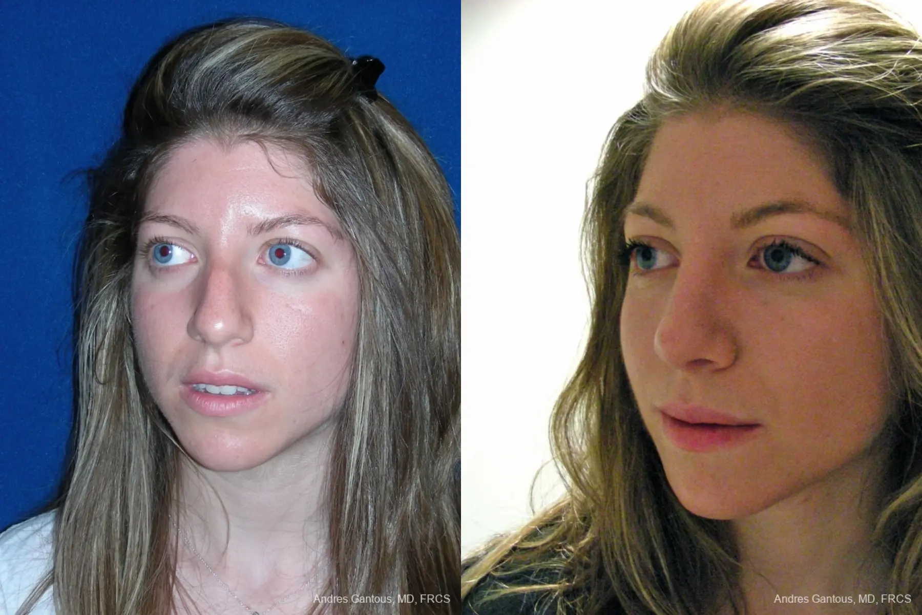 Rhinoplasty: Patient 50 - Before and After 2
