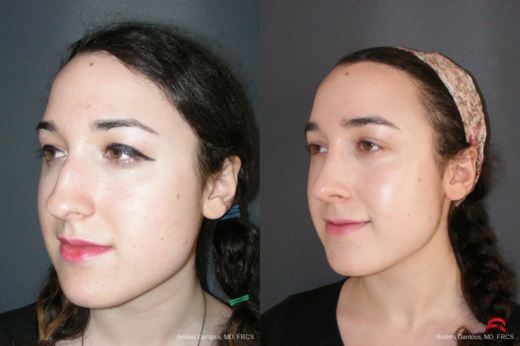 Rhinoplasty: Patient 57 - Before and After 4