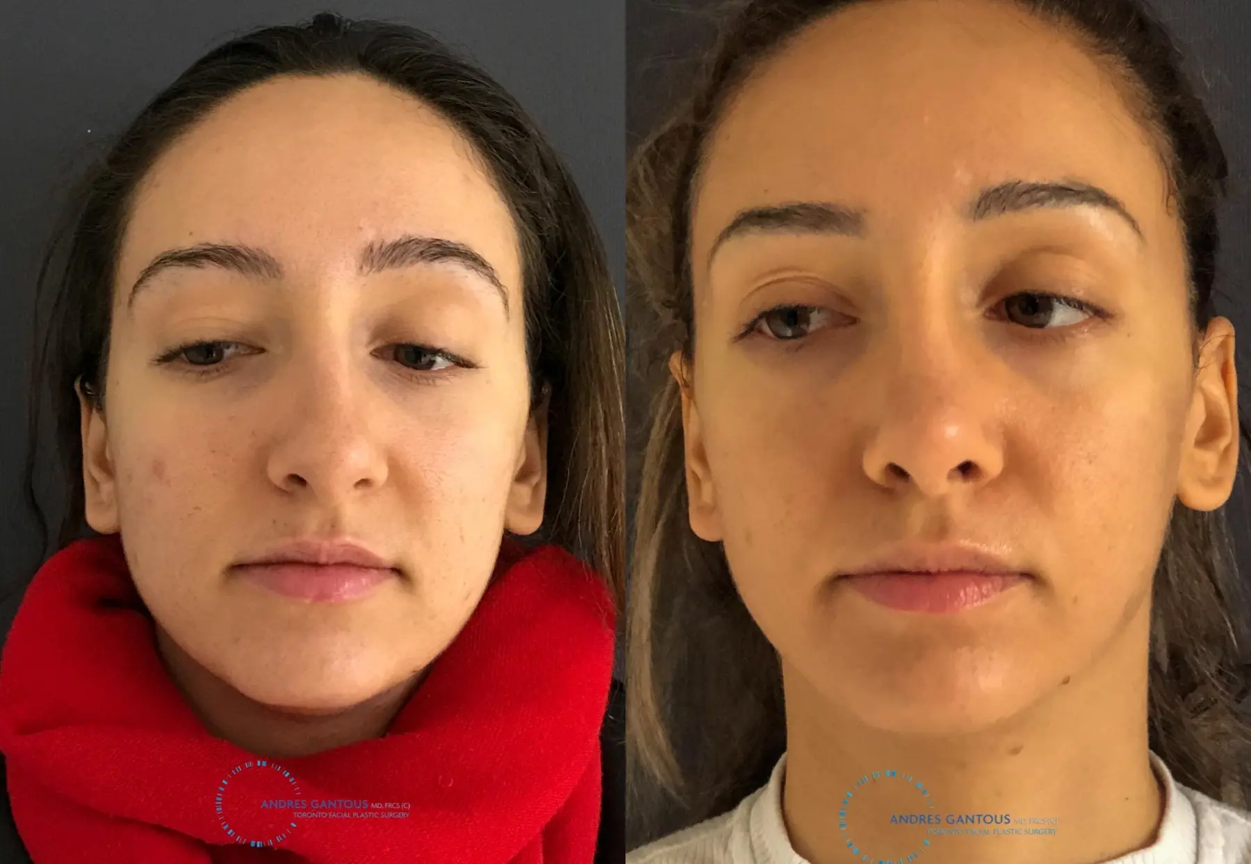 Rhinoplasty: Patient 59 - Before and After  