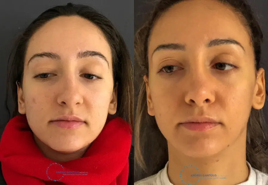Rhinoplasty: Patient 59 - Before and After 1
