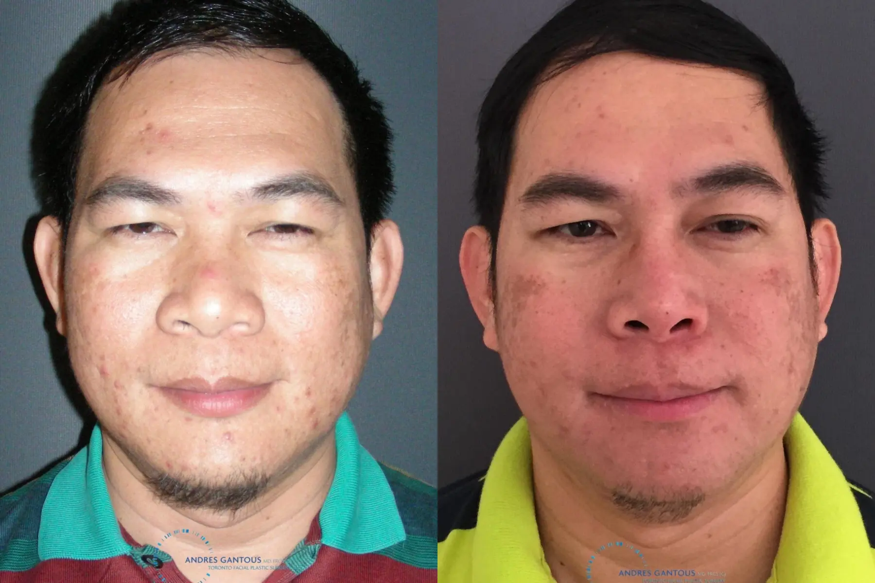 Rhinoplasty: Patient 61 - Before and After  