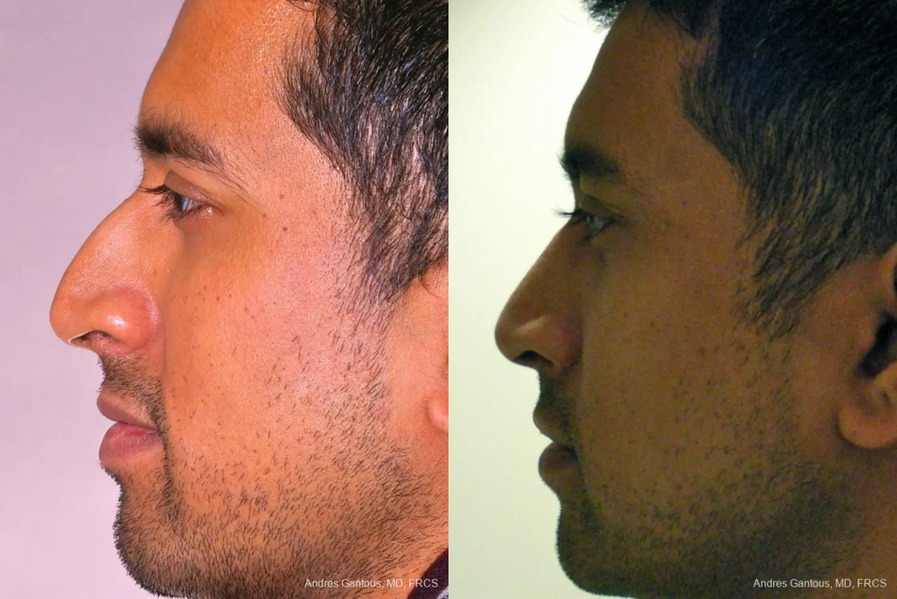 Rhinoplasty: Patient 23 - Before and After 4