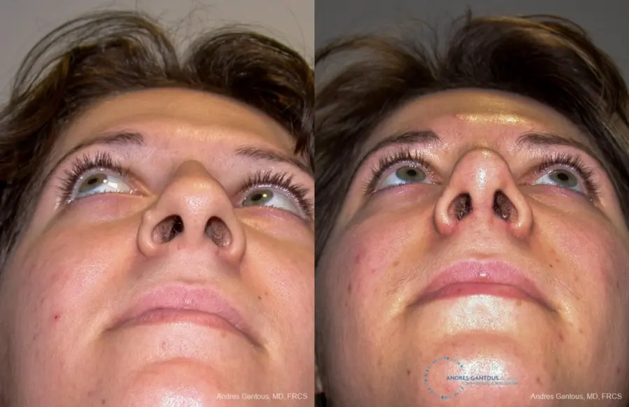 Rhinoplasty: Patient 90 - Before and After 2