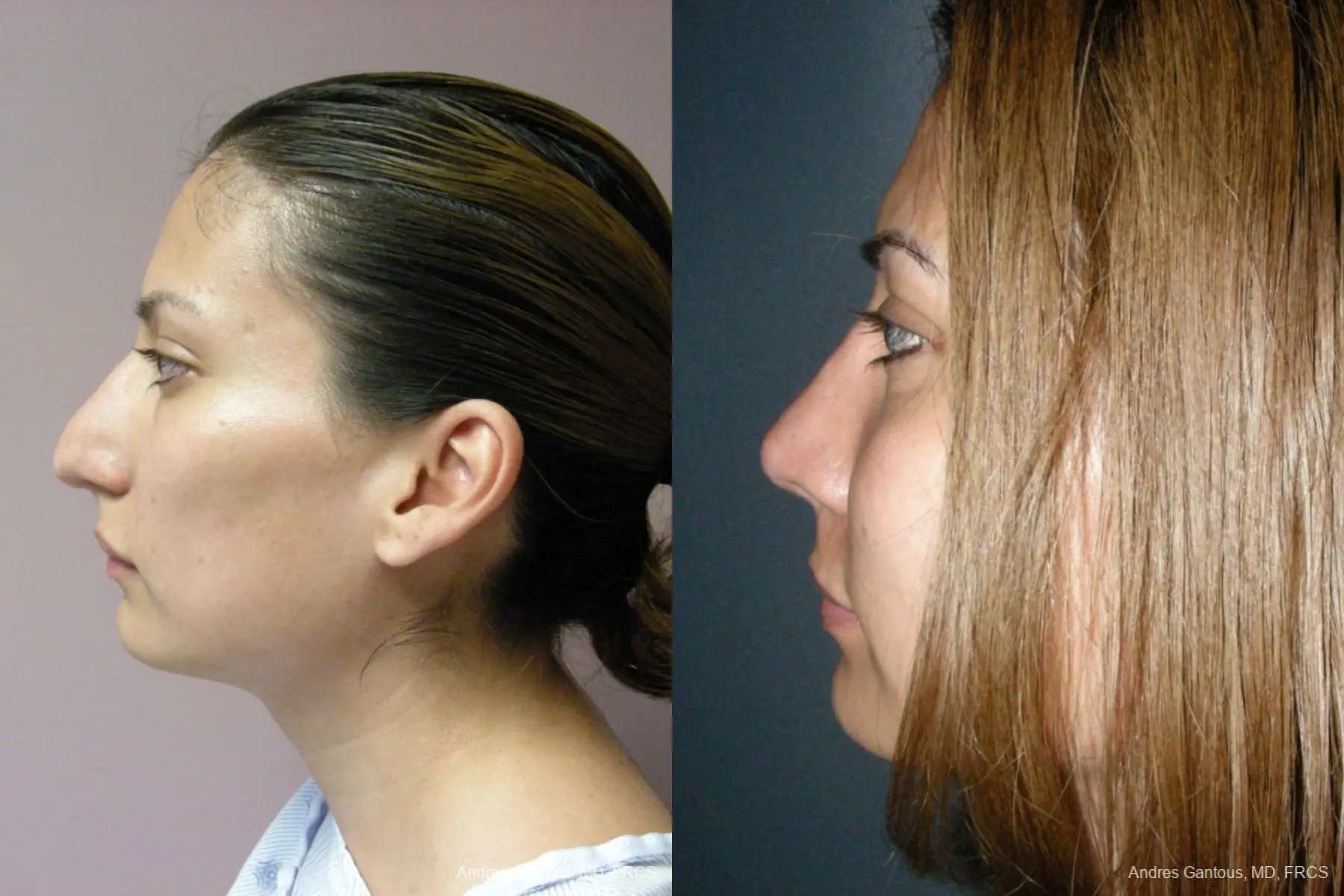 Rhinoplasty: Patient 56 - Before and After 5