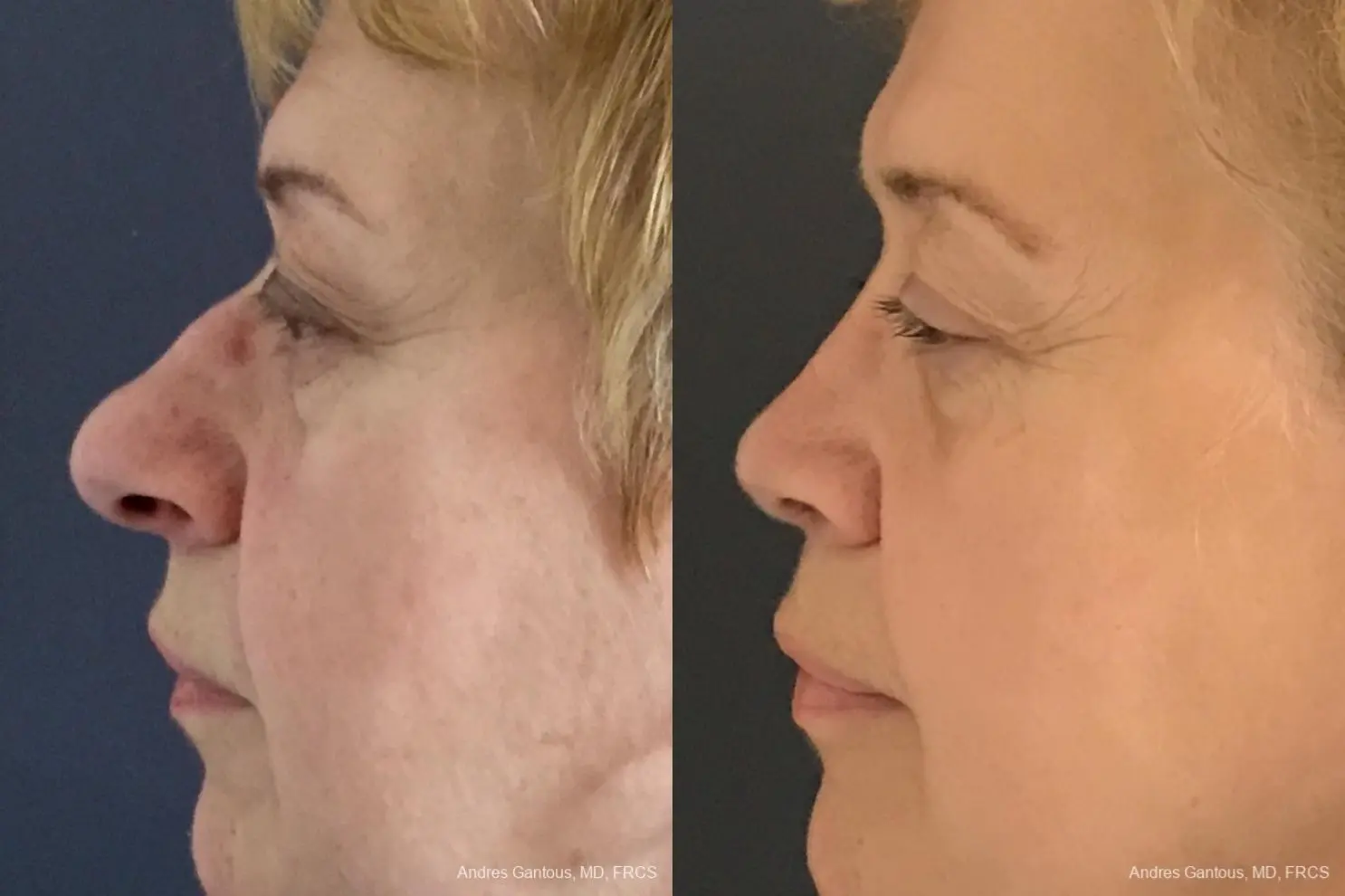 Rhinoplasty: Patient 20 - Before and After 5