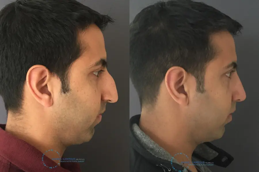 Rhinoplasty: Patient 76 - Before and After 5