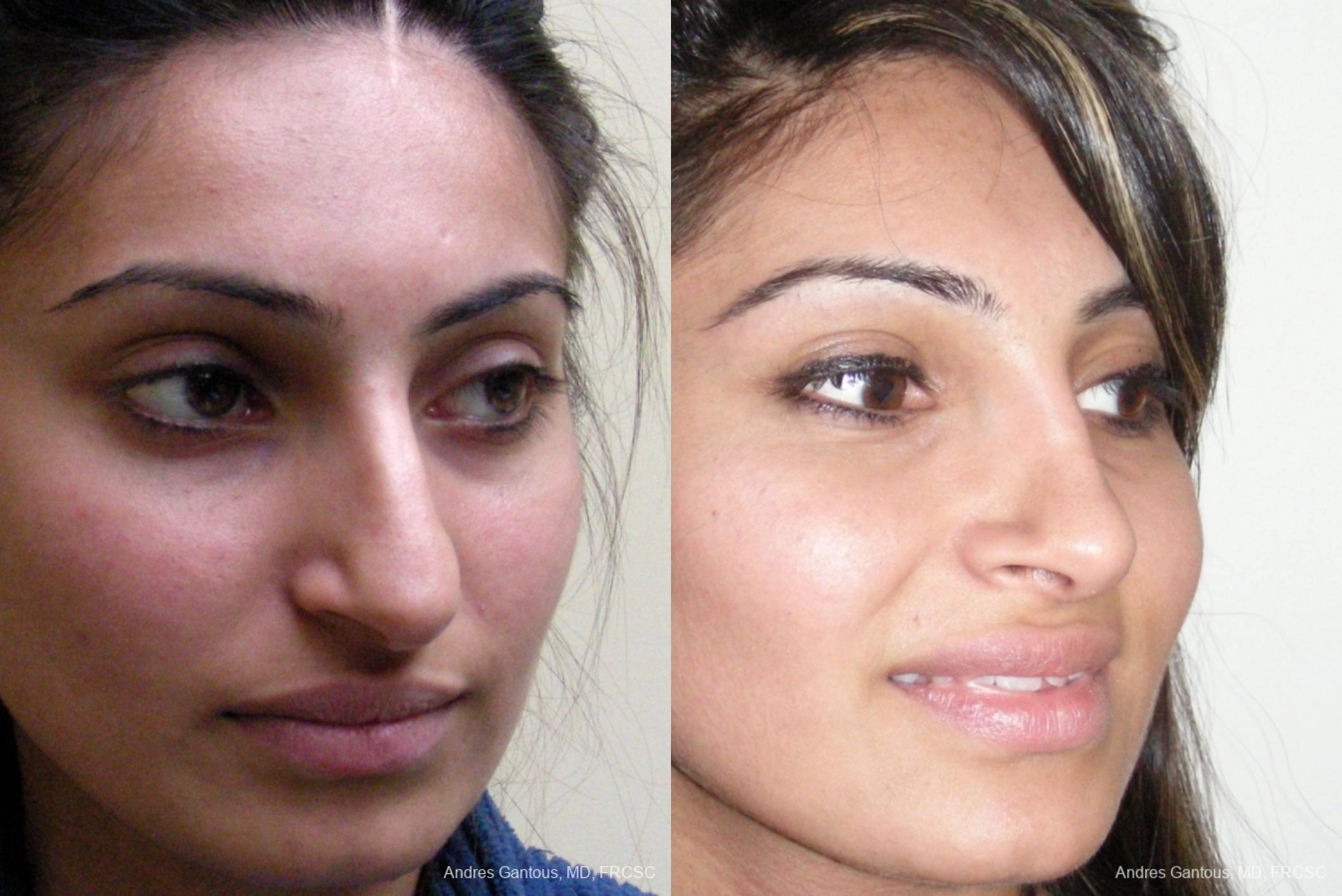 Rhinoplasty - Thumbnail 2