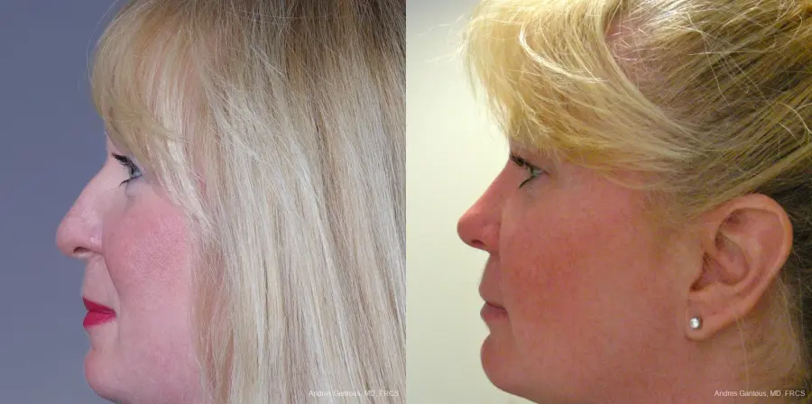 Rhinoplasty: Patient 37 - Before and After 5