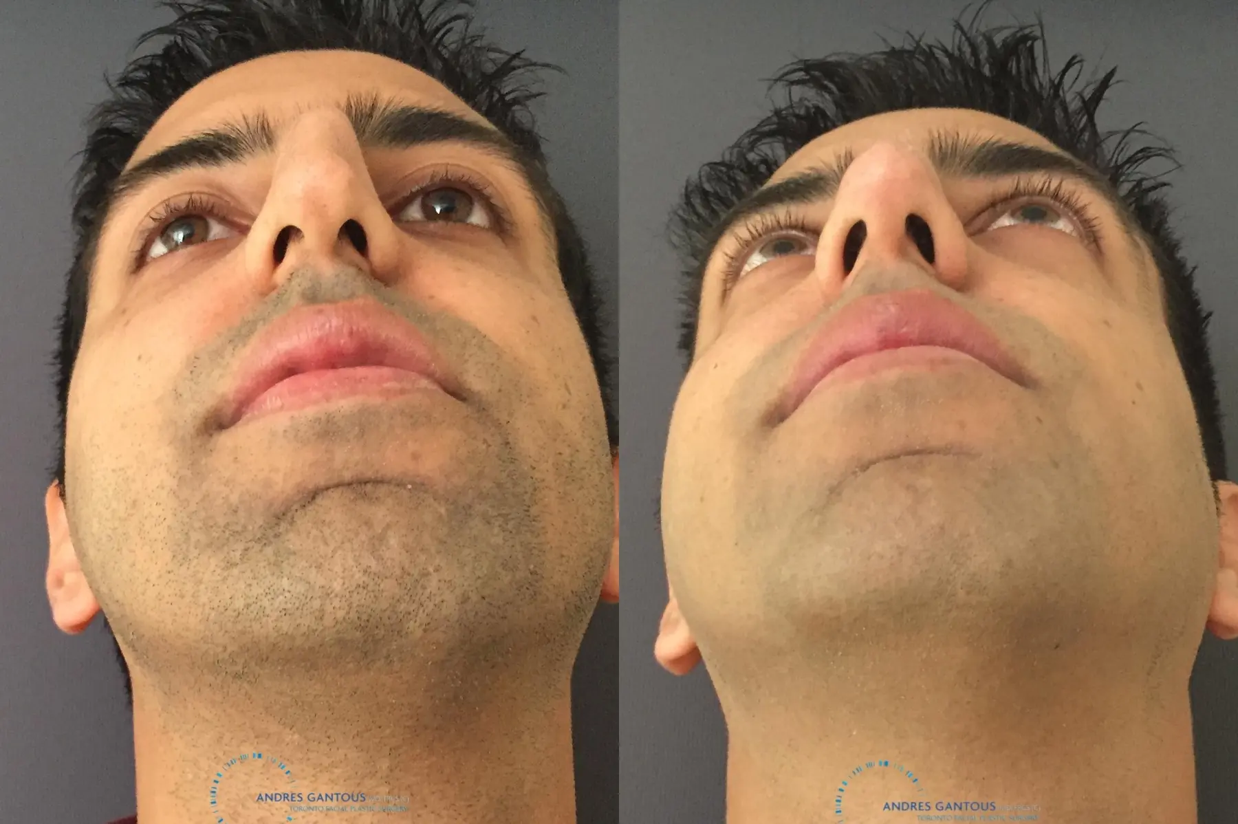 Rhinoplasty: Patient 76 - Before and After 2