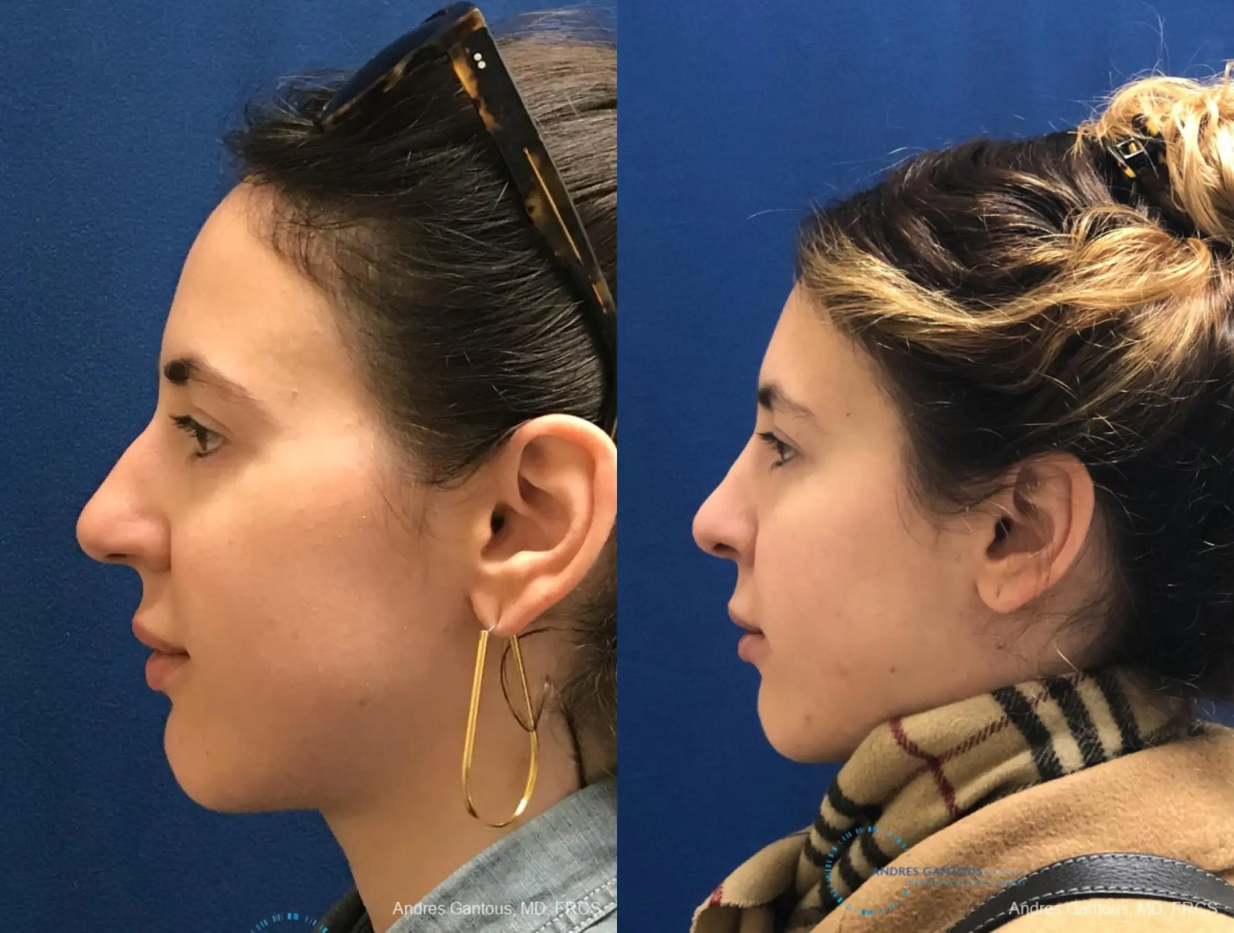 Rhinoplasty: Patient 84 - Before and After 6
