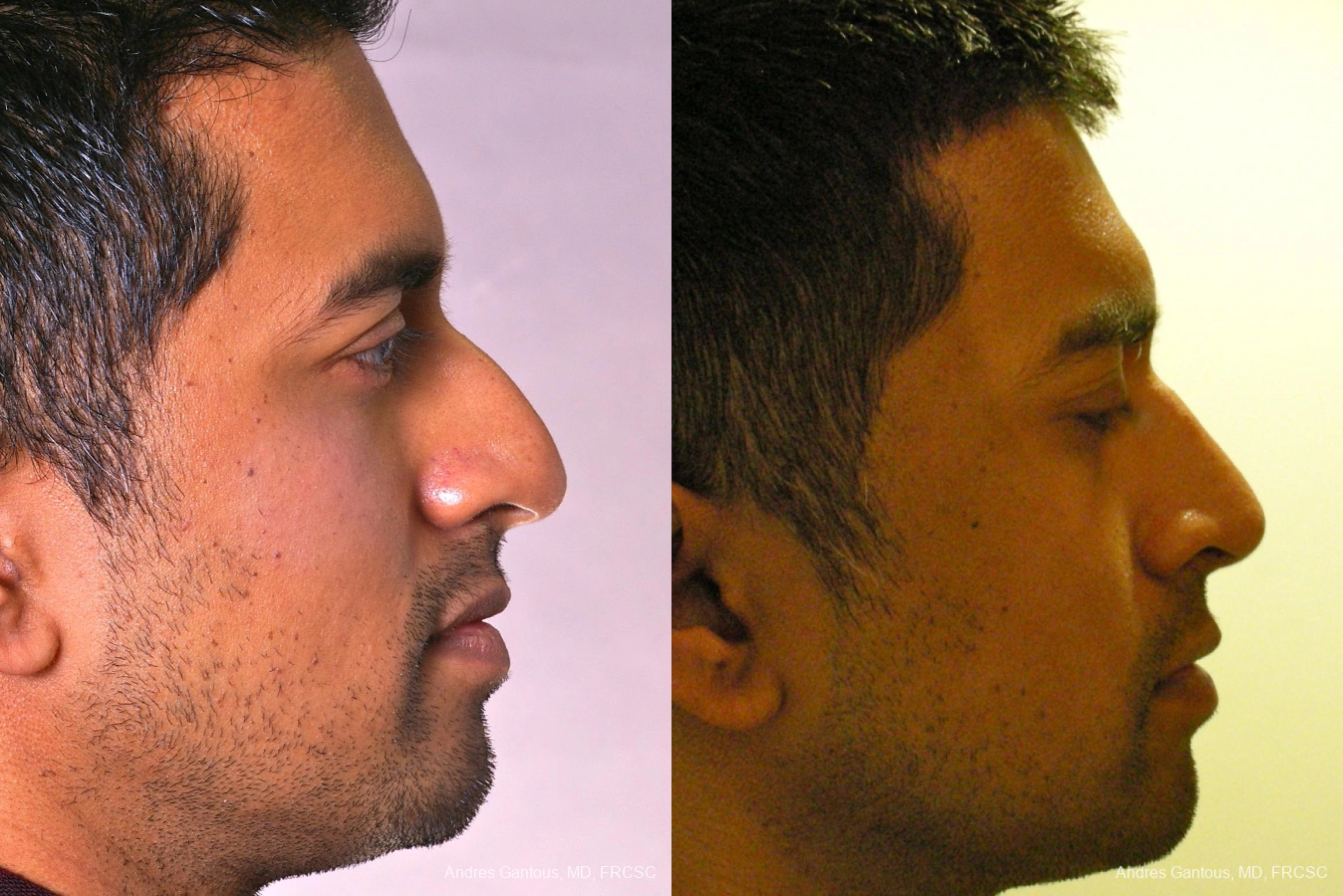 Rhinoplasty - Thumbnail 5