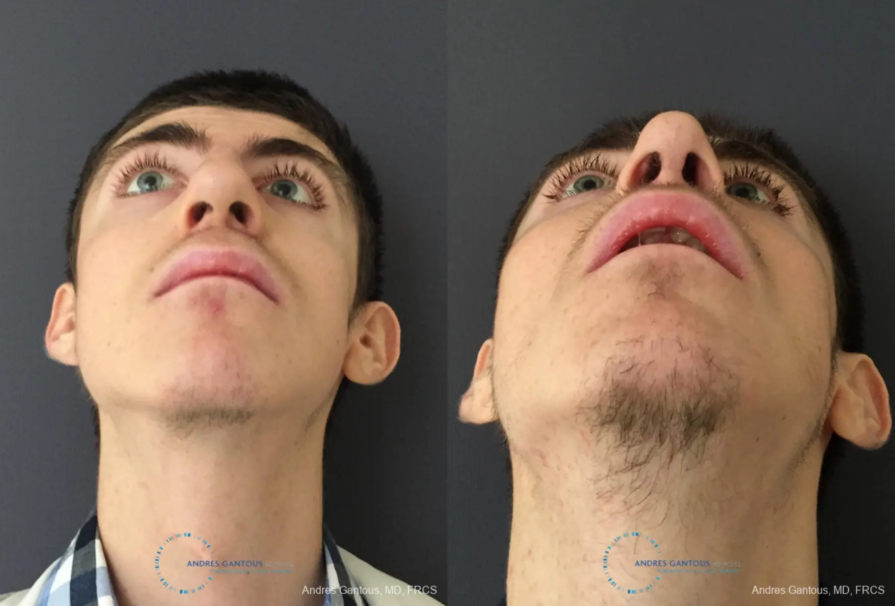 Rhinoplasty: Patient 80 - Before and After 2