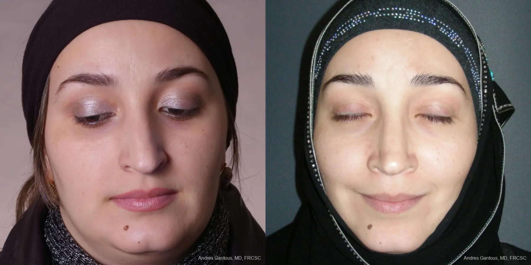 Rhinoplasty: Patient 51 - Before and After  