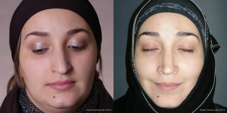 Rhinoplasty: Patient 51 - Before and After 1