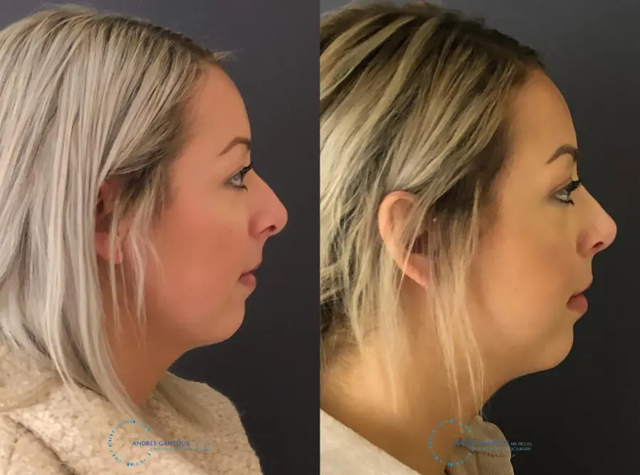Rhinoplasty: Patient 71 - Before and After 6