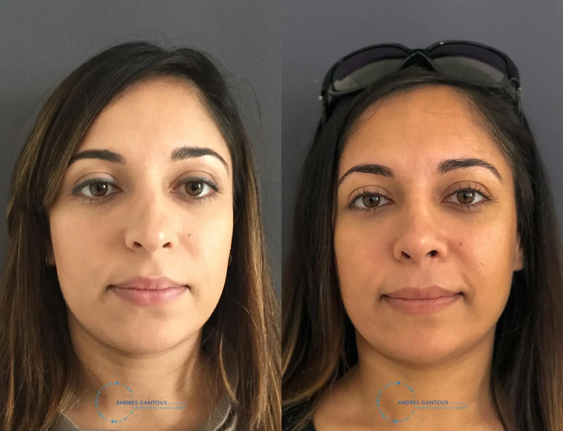 Rhinoplasty: Patient 3 - Before and After  
