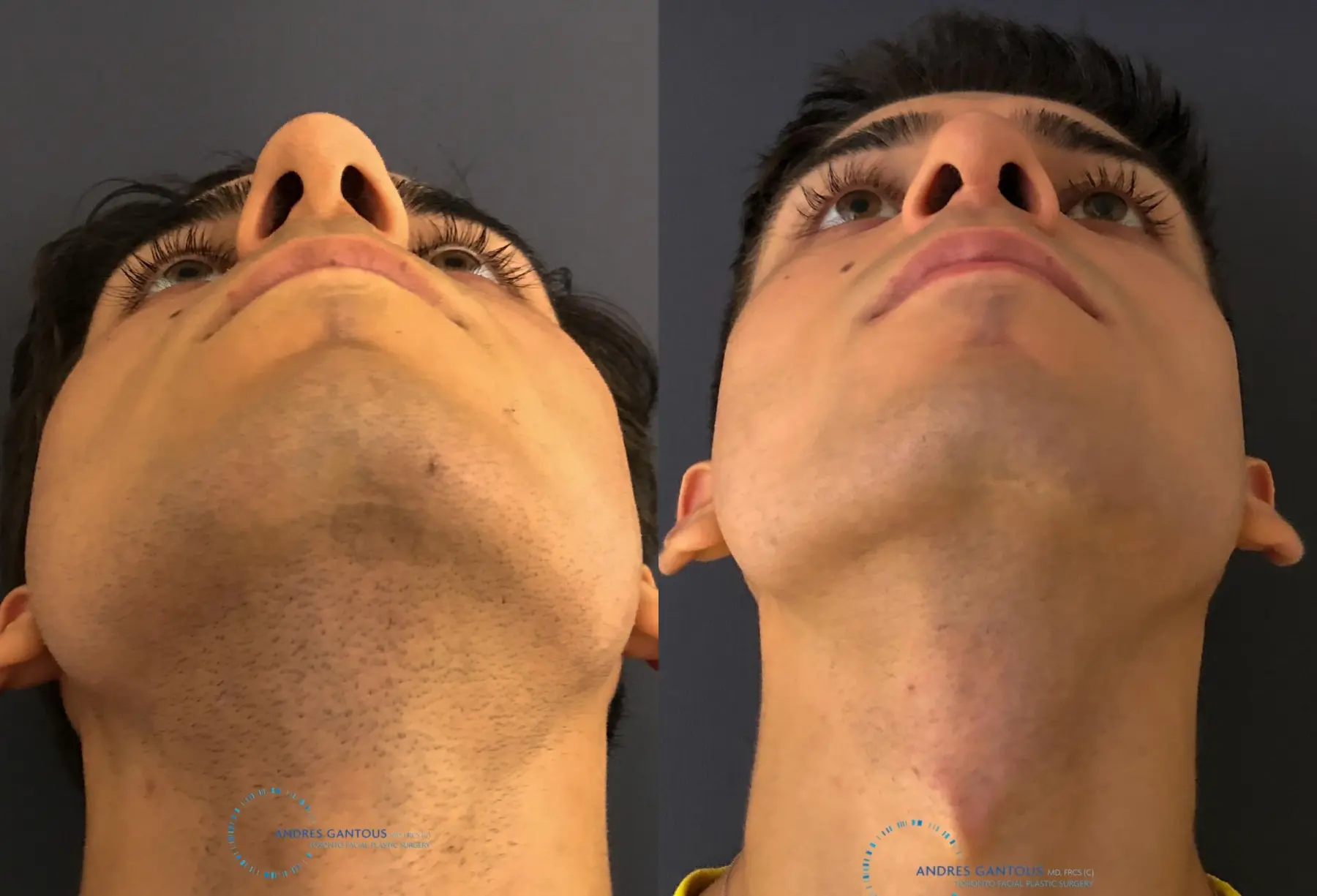 Rhinoplasty: Patient 65 - Before and After 2