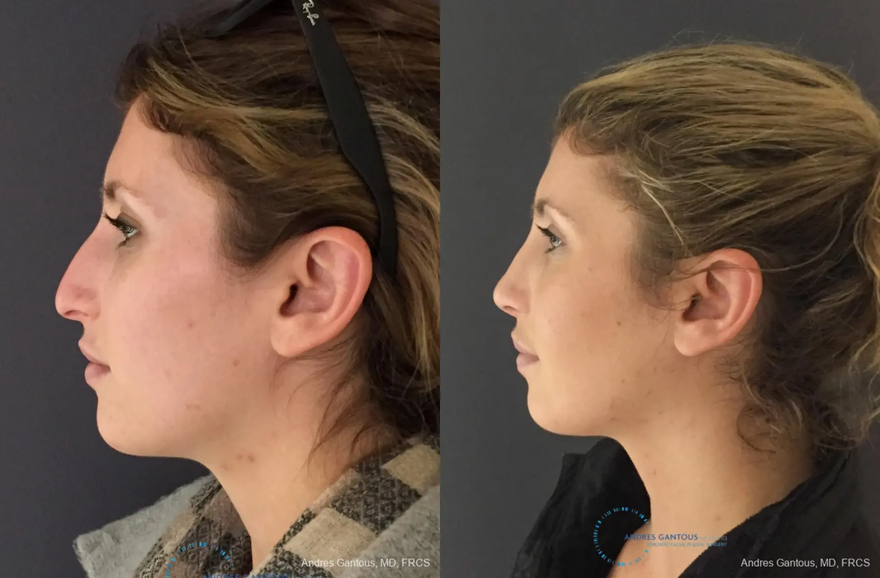 Rhinoplasty: Patient 77 - Before and After 6
